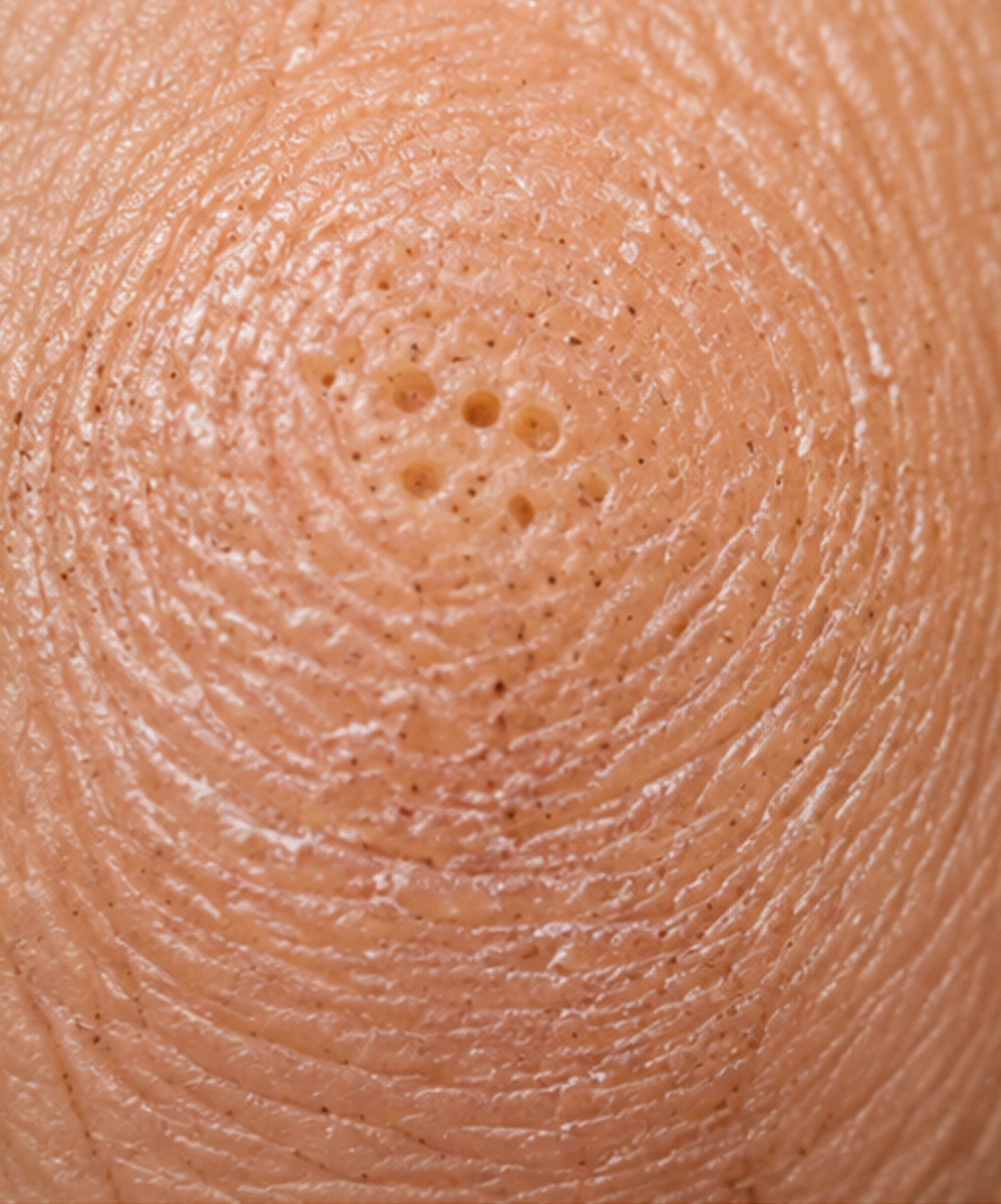 Hiperkeratoza